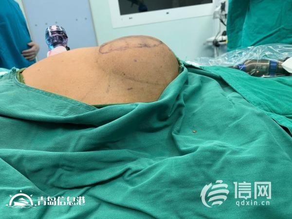 勿以“疝”小而不為 專家建議：及早干預才是明智之選